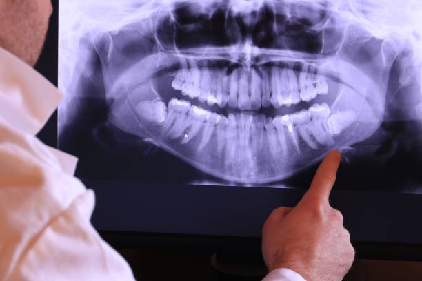 Best Emergency Dentist for Lost Fillings or Crowns in West Hills, NY